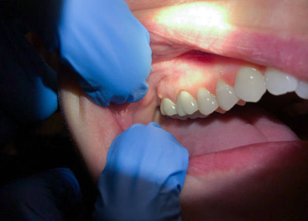 Best Emergency Tooth Extraction in West Sharyland, TX