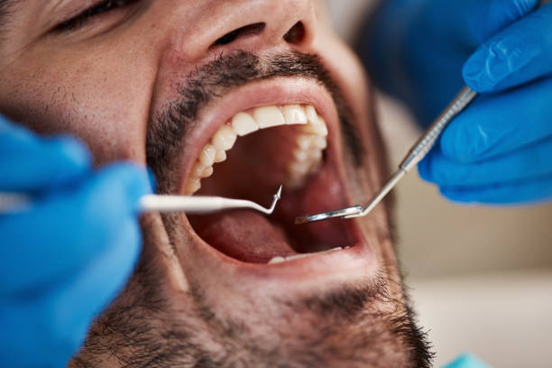 Best Emergency Tooth Extraction in West Sharyland, TX